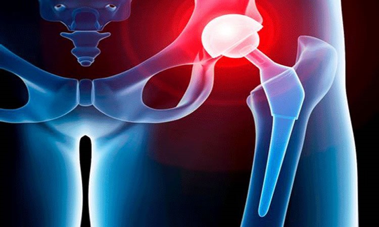 Revision Hip Surgery